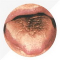 Black Tongue Coating