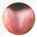 Tongue Pale and Enlarged, with purple spots