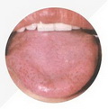 Pale Red Tongue,with purple spots