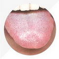 Pale Red Tongue,tongue coating thin and white