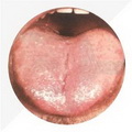 Enlarged Tender Tongue,Pale White