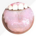 Pale Enlarged Tongue,with tooth-marks