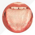 Pale Tongue,with white greasy coating