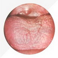 Cracked Tongue,Flour Dry coating