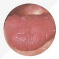 Cracked Tongue,deep-red tongue