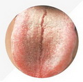 Cracked Tongue,tongue coating white and greasy