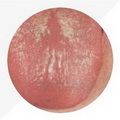 Map Tongue,tongue proper red