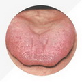 Tongue Proper Red,tongue coating thin and yellow