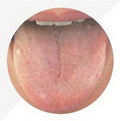Pale Red Tongue,tongue coating thin and white