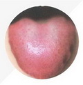 Tongue Proper Red,less tongue coating