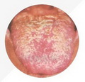 Curdy Tongue Coating