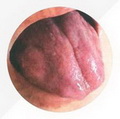Deep-red tongue
