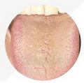 Dry Tongue Coating