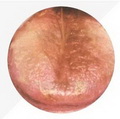 Gray Tongue Coating