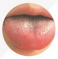 Red tongue
