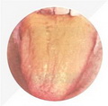 Yellow Tongue Coating