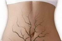 The obvious cause of blue veins in all parts of the body 04