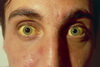 appear icteric