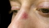 spider nevus